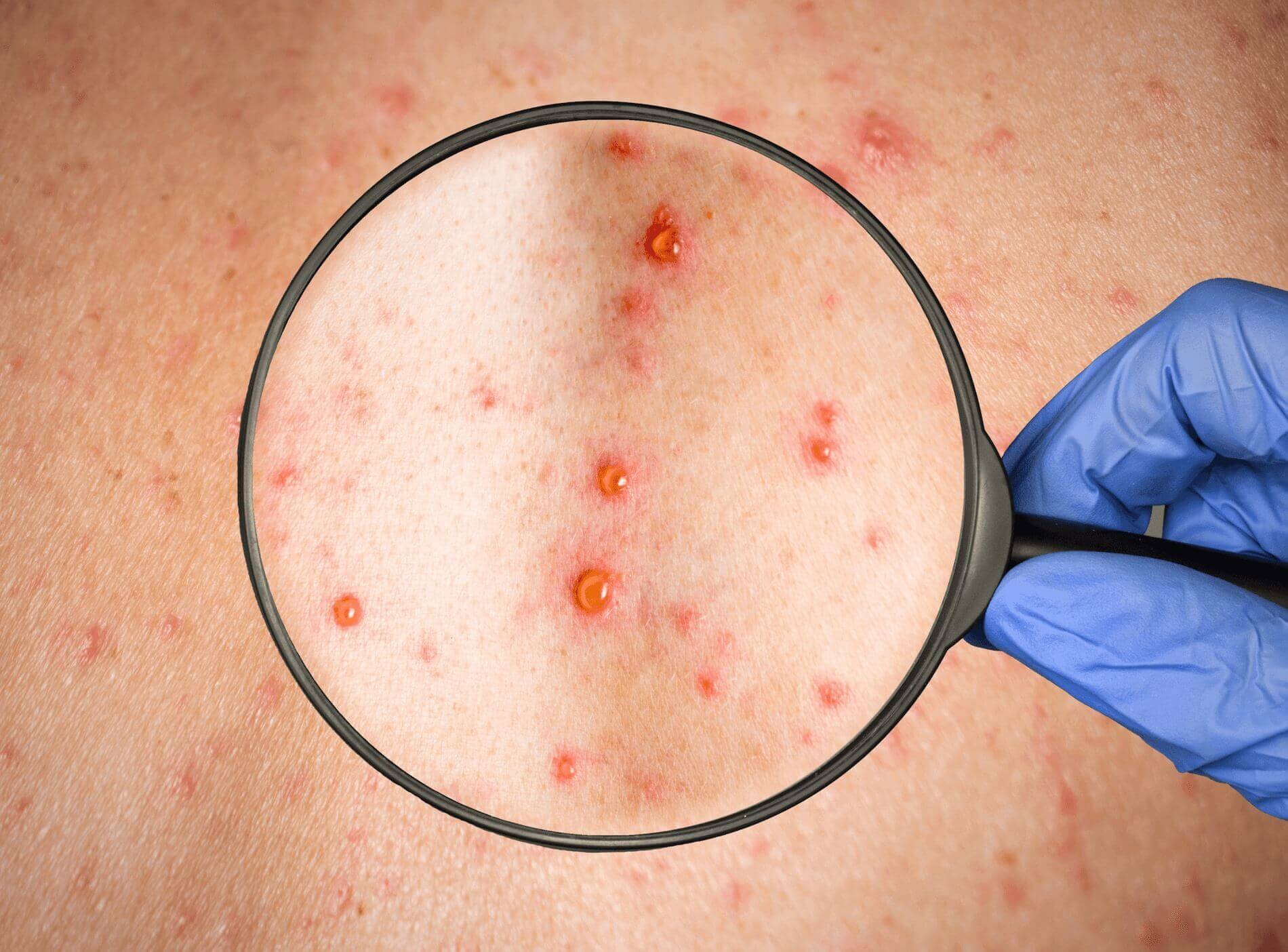 Rubéola: Infecção viral contagiosa evitável por vacina e conhecida pela sua erupção vermelha característica.
