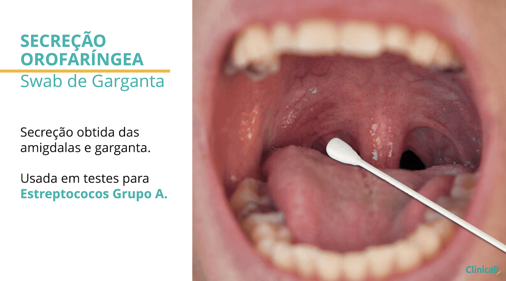 Secreção orofaríngea com swab de garganta para teste rápido de streptococcus